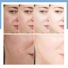 Load image into Gallery viewer, Salicylic Acid Anti-Acne Essence