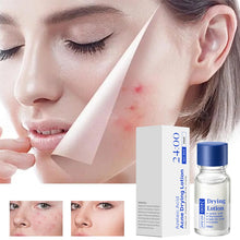 Load image into Gallery viewer, Salicylic Acid Anti-Acne Essence