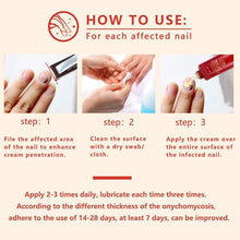 Load image into Gallery viewer, Nail Care Treatment of Anti-Fungal Cream