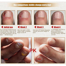 Load image into Gallery viewer, Nail Care Treatment of Anti-Fungal Cream
