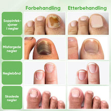 Load image into Gallery viewer, Ingefær neglebehandling