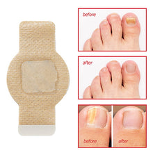 Load image into Gallery viewer, Fungal Nail Patches