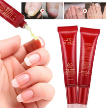 Load image into Gallery viewer, Nail Care Treatment of Anti-Fungal Cream